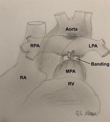 Pulmonary artery banding: a 20-year experience at a tertiary care center in a developing country